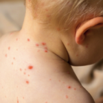 Eight cases of measles in Greece, an increase is expected – Concern for a resurgence in Europe